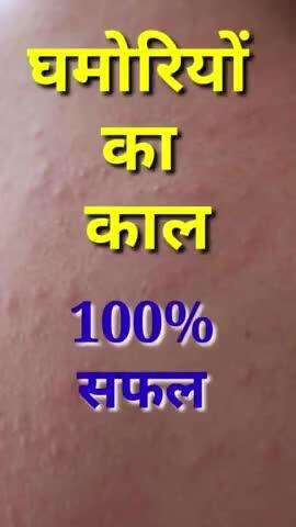 अब होगी घमोरियों से मुक्ति ! सफल इलाज! Ghamori ka safal ilaj ! Heat rash treatment #ghamori #vinodjivlogs