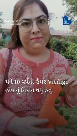 મને 10 વર્ષની ઉંમરે મને Vitiligo  હોવાનું નિદાન થયું હતું. #ashi.toys.studio 
#Inspiring #MondayMotivation