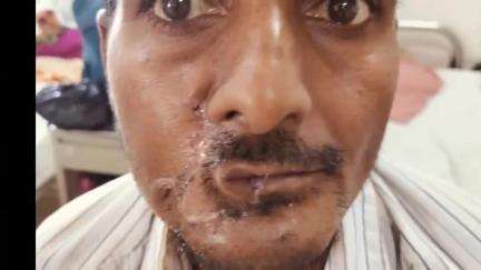 सैफई: होंठ के कैंसर से जूझ रहे मरीज का सैफई विवि में सफल इलाज, डॉक्टरों ने दी नई जिंदगी