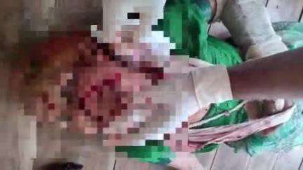 बाह: बासौनी में पालतू पिटबुल डॉग ने 65 वर्षीय बुजुर्ग पर किया जानलेवा हमला