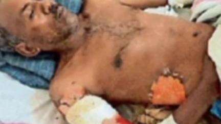 बनखेड़ी: कामती में बिना सुरक्षा उपकरण के काम करते समय बिजली कंपनी के कर्मी को लगा करंट, भोपाल रेफर