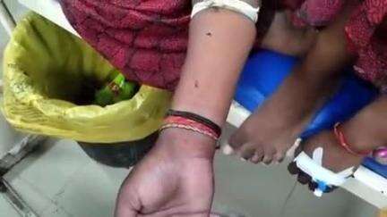 हाथरस: गांव पाली रजापुर में कंडे निकालते समय एक किशोरी को सांप ने काटा, हालत बिगड़ने पर परिजन किशोरी को जिला अस्पताल लेकर आए