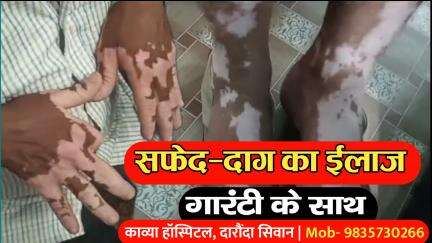 गोपालगंज: सिवान जिले के काव्या हॉस्पिटल में सफेद दाग का गारंटी के साथ हो रहा है इलाज, दवा का असर नहीं तो पैसा वापस