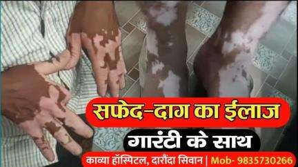 गोरखपुर: सिवान जिले के काव्या हॉस्पिटल में सफेद दाग का गारंटी के साथ हो रहा है इलाज, दवा का असर नहीं तो पैसा वापस | 9835730266
