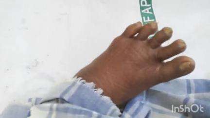 ఆదోని: విరుపాపురంలో పాము కాటుకు గురైన మహిళకు అస్వస్థత