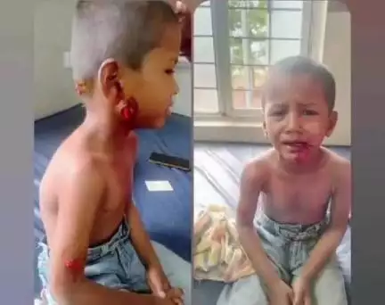 బిచ్కుంద: ఎల్లమ్మ కుచ్చాలో చిన్నారి పై వీధి కుక్కల దాడి