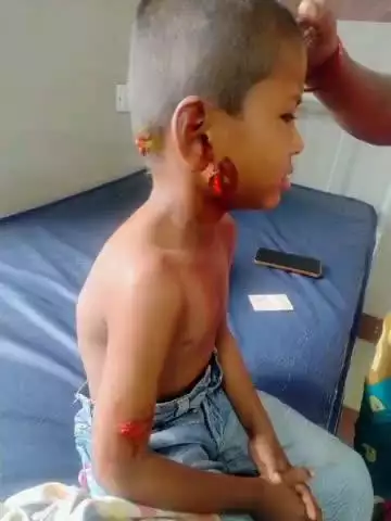 బిచ్కుంద: బిచ్కుందలో బాలుడిపై  కుక్కల దాడి