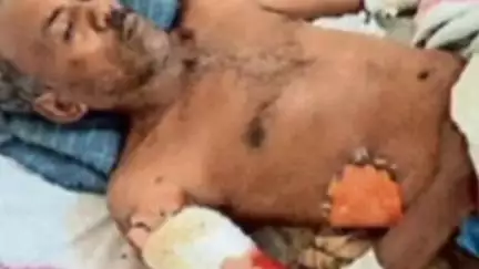 कामती में बिना सुरक्षा उपकरण के काम करने के दौरान बिजली कंपनी के कर्मी को करंट लगा, भोपाल किया रेफर