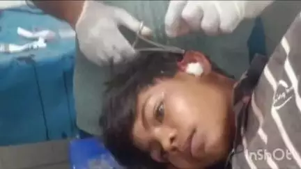 उंटारी रोड: पांडेयपुर में क्रिकेट खेल रहे 15 वर्षीय किशोर को गांव के ही 40 वर्षीय व्यक्ति ने दांत से काटा