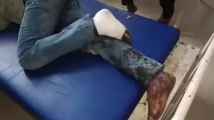 नरसिंहपुर: लालपुल के पास बंदरों के हमले से बाइक गड्ढे में गिरी, युवक घायल