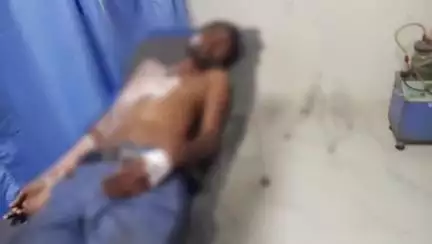 सिवान: पचरुखी के उमेश पैलेस में काम कर रहा मजदूर गर्म पानी से झुलसा, इलाज जारी