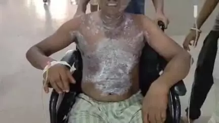 फर्रुखाबाद: गंगानगर में मोमोज बनाते समय गैस सिलेंडर में आग लगने से अधेड़ व्यक्ति झुलस गया, अस्पताल में कराया गया भर्ती