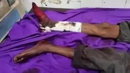 हाथरस: गांव जरेरा के पास अनियंत्रित होकर ई-रिक्शा पलटने से चालक का पैर टूटा, परिजन अस्पताल पहुंचे
