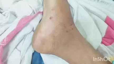 जहानाबाद: ओयना लाखापुर में खेत से लौटते समय नवयुवक को सांप ने काटा, हालत बिगड़ने पर सदर अस्पताल में भर्ती
