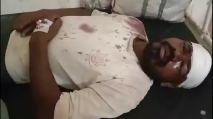 बुरहानपुर नगर: बुरहानपुर सराय: जीजा ने पारिवारिक विवाद में साले पर पत्थर से किया हमला, अस्पताल में भर्ती