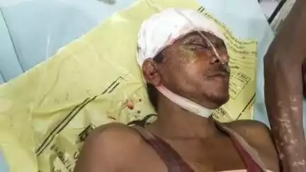 भीलवाड़ा: बिगोद में दीवार ढहने से कारीगर घायल, जिला अस्पताल से हायर सेंटर किया गया रेफर