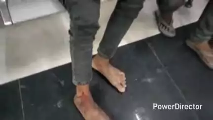 कटिहार: घोरदह में खेत जाते समय नाबालिग को जहरीले सांप ने डंसा, अस्पताल में भर्ती
