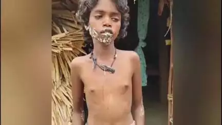 కొవ్వూరు: గిరిజన చిన్నారి ఒళ్లంతా వాతలు..ఇందుకూరుపేట మండలం కాకర్ల దిబ్బలో దారుణ ఘటన