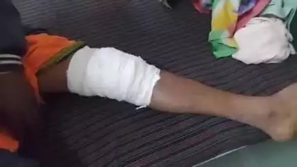 शहपुरा: रमपुरी गांव में शादी में डीजे पर नाचते समय युवक फिसलकर गिरा, पैर टूटा, शहपुरा अस्पताल में इलाज जारी
