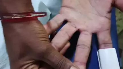 जशपुर: पुआल लेते वक्त सांप ने डसा, पत्नी की सूझबूझ से पति समय पर अस्पताल पहुंचा, जिला अस्पताल में इलाज जारी