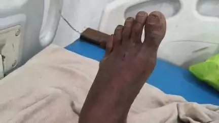 लोहरदगा: मुर्की तोड़ार मैना टोली में सांप काटने से एक व्यक्ति गंभीर, रिम्स रेफर