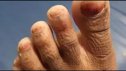 काको: भासरा गांव में सांप पर पैर रखने से किशोरी को सांप ने काटा