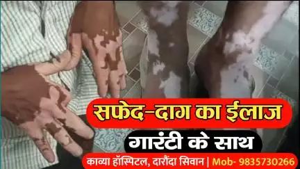 आगरा: सिवान जिले के काव्या हॉस्पिटल में सफेद दाग का गारंटी के साथ हो रहा है इलाज, दवा का असर नहीं तो पैसा वापस | 9835730266