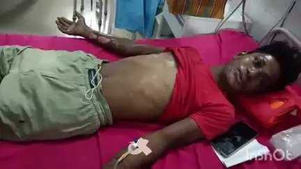 मुंगेर: बिंदवाड़ा में 11000 वोल्ट के तार की चपेट में आने से युवक घायल, अस्पताल में भर्ती