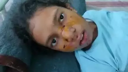 भिंड नगर: बरुआ नगर में बंदर ने बच्ची पर किया हमला, बच्ची घायल