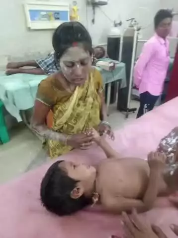 पंडरिया: ग्राम रूसे में खाना बनाते समय चावल के गरम पानी से झुलसे दो बच्चे और उनकी मां, जिला अस्पताल में भर्ती