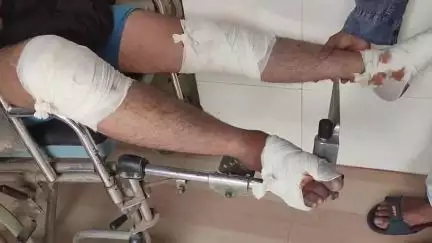 নাকাশিপাড়া: নাকাশিপাড়া টোলের  কাছে লরির সঙ্গে টোটোর সংঘর্ষ আহত টোটো চালক আনা হলে বেথুয়াডহরি হাসপাতালে