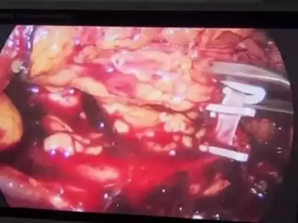 औरंगाबाद: शहर के यूरोलॉजिस्ट डॉक्टर प्रभात कुमार मिश्रा ने राइट रेडिकल नेफ्रोयूरेटेक्टोमी की सफल सर्जरी कर जिले के पहले सर्जन बने