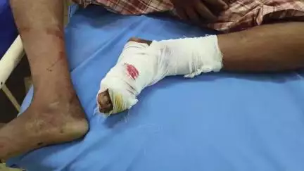 ગોધરા: અણીયાદ ગામે લાકડું કાપતા સમયે ગ્રાન્ડર મશીન પગના ભાગે વાગતા ગંભીર ઇજાઓ પહોંચી હતી