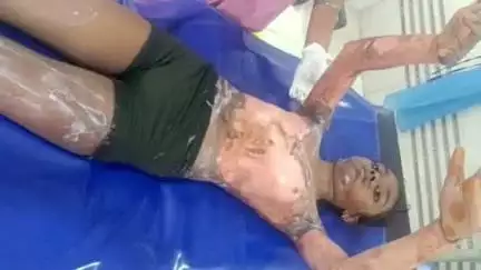ములుగు: కొత్త మల్లూరుకు చెందిన ఓ చిన్నారిపై వేడి గంజినీరు పడడంతో తీవ్ర గాయాలు