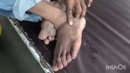 खामगाव: खामगाव शहरातील बर्डे प्लॉट भागात एका कुत्र्याने एका इसमास चावा घेतल्याने इसम जखमी