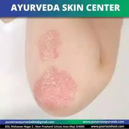 Psoriasis treatment by ayurveda skin hospital kota 
9587066074