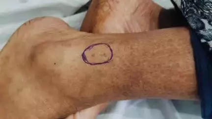 कुनकुरी: कुनकुरी में सर्पदंश की शिकार महिला का सामुदायिक स्वास्थ्य केंद्र में सफल उपचार