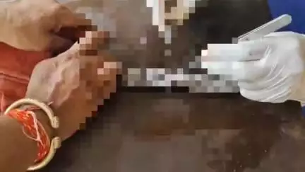 अजमेर: शास्त्री नगर में 8 फीट के जहरीले कोबरा सांप की सर्जरी, इंसानों की सर्जरी से है अलग