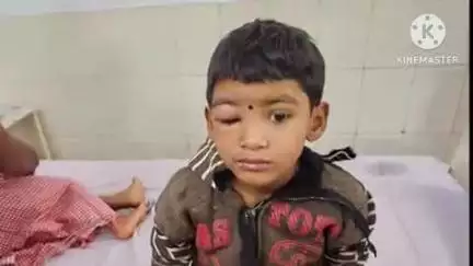 भानुप्रतापपुर: ग्राम खोरागांव में भोंगरा किडा के काटने से आंगनबाड़ी के चार बच्चे हुए घायल