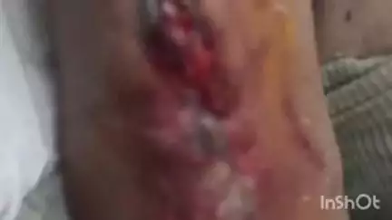इटारसी: ग्राम ढाबा खुर्द में ट्रैक्टर ट्राली नाले में गिरी, JCB से घायल निकाला गया, इटारसी अस्पताल में इलाज जारी