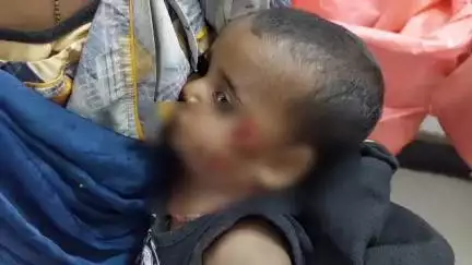 पाली: रानी के चचौड़ी में 9 माह की मासूम को पालतू स्वान ने नोंच लिया, ट्रॉमा सेंटर में किया गया उपचार