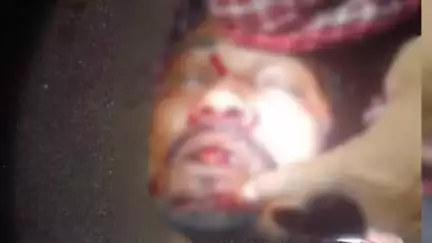 कांके: पिठौरिया थाना क्षेत्र के पिरुटोला मदरसे के पास सड़क हादसे में बाइक सवार घायल