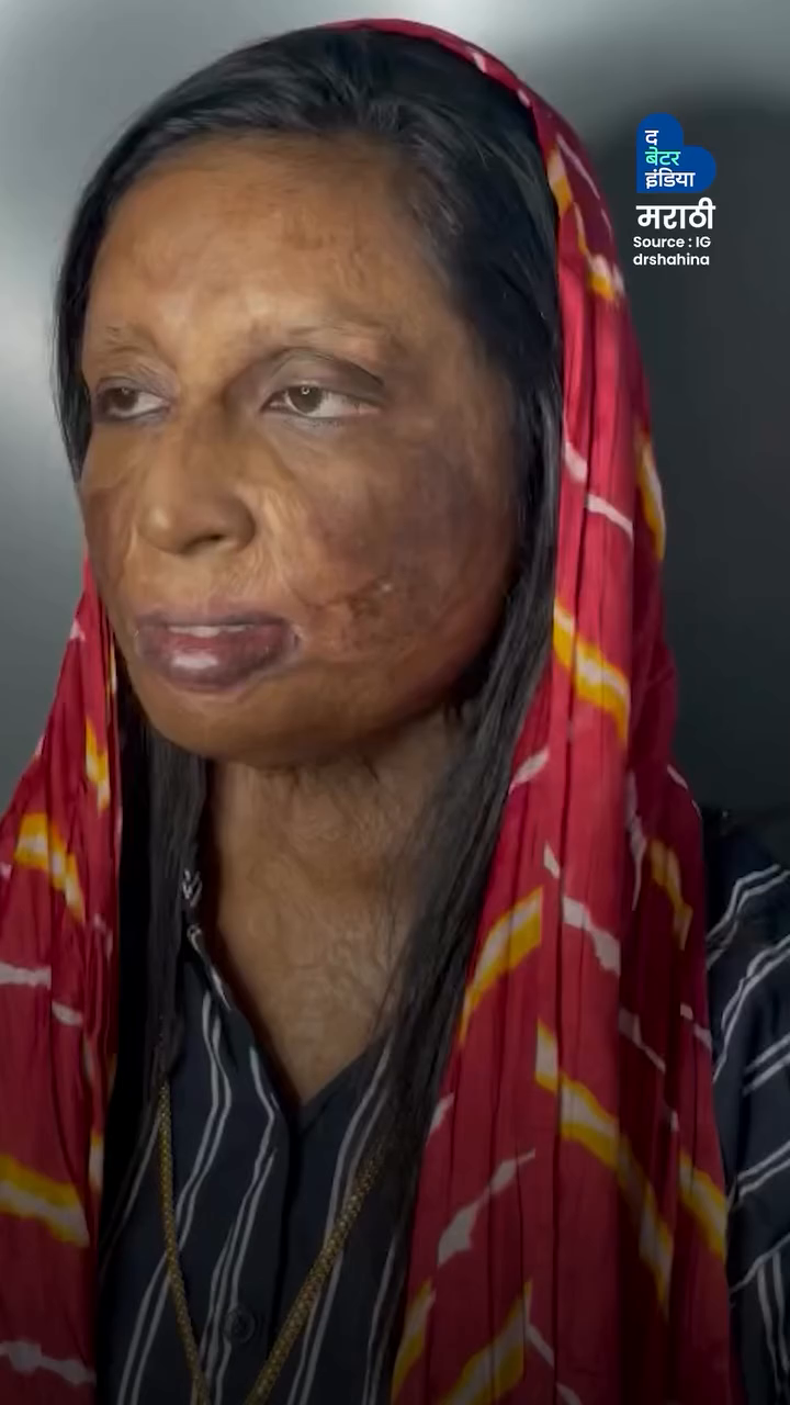 माझी ओळख माझे काम आहे, जळलेला चेहरा नाही Dr.Shahina | Inspiration | Personal Struggle